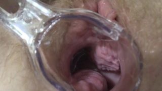 Reife Lesben spielen beim Gynäkologen, öffnen die Vagina mit einem medizinischen Dilatator und untersuchen den Gebärmutterhals.